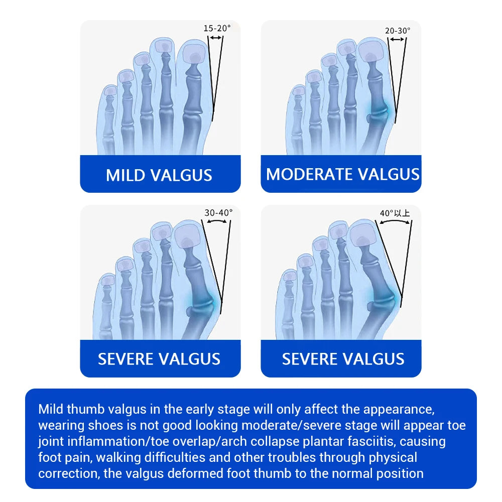 Adjustable Bunion Corrector with Rotatable Toe Separator – Unisex.